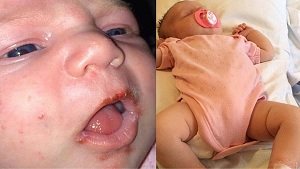 Trẻ 2 tuổi mắc Herpes, chuyên gia nêu nguyên nhân không ai ngờ tới