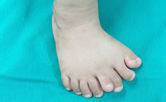Kỳ lạ: Bàn chân của bé trai có 9 ngón