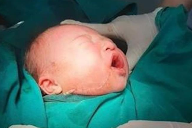 Đẻ tại nhà, bé vừa chào đời bị rách mặt do rơi vào dao cắt rốn