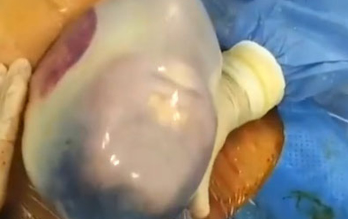 Ngỡ ngàng cặp song sinh chào đời vẫn nằm trong túi ối