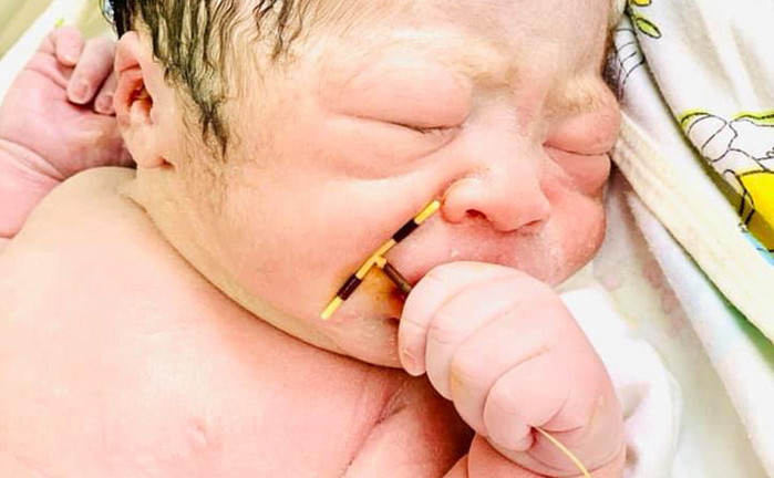 Em bé chào đời với vòng tránh thai, dân mạng bình luận hài hước