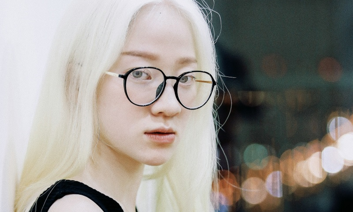 Cô gái bạch tạng Hà Nội bỗng nổi tiếng khắp cộng đồng mạng