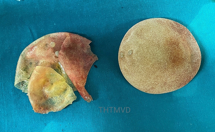 Người phụ nữ vỡ túi ngực silicone mà không hay biết