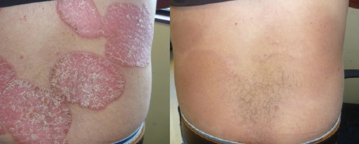 Kiểm soát hiệu quả bệnh vẩy nến bằng kết hợp thảo dược