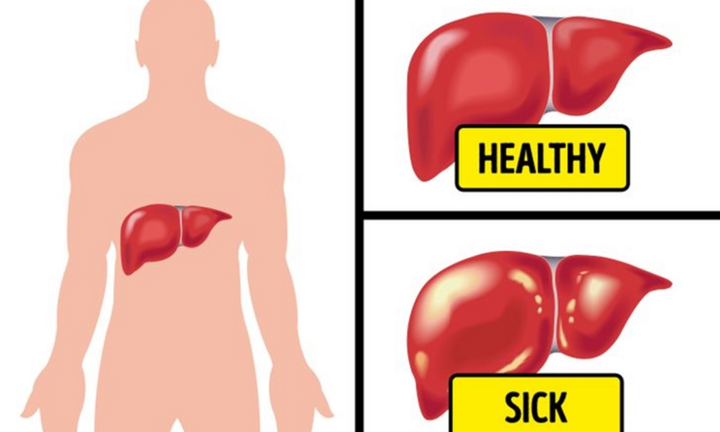 Đầy hơi kéo dài, có thể bạn đang đối mặt với các bệnh nguy hiểm sau