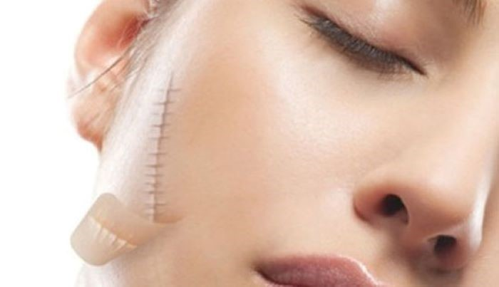 Những biến chứng nguy hiểm khi phẫu thuật thẩm mỹ 