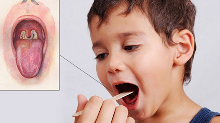 50% bệnh nhân bạch hầu không có triệu chứng