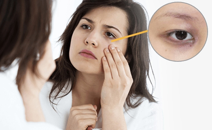 Quầng thâm mắt là dấu hiệu của những bệnh nguy hiểm nào?