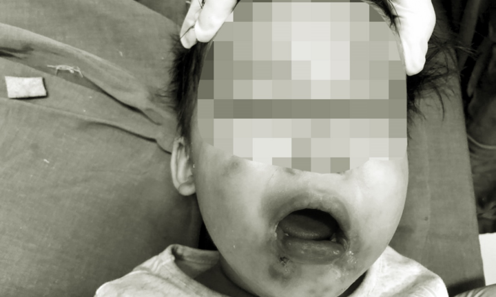 Cắn dây điện khi ngồi chơi, bé gái 2 tuổi ở Yên Bái bất tỉnh, nhập viện khẩn cấp