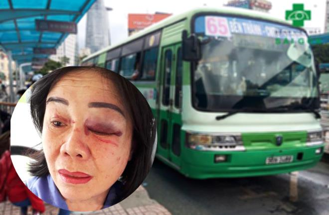 Công an điều tra vụ nữ tiếp viên xe buýt bị hành khách đánh bầm mắt