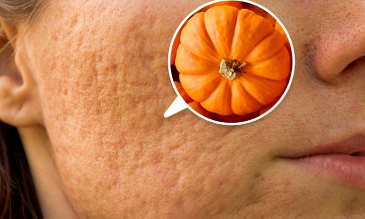 7 thực phẩm làm mờ sẹo mụn nhanh và an toàn