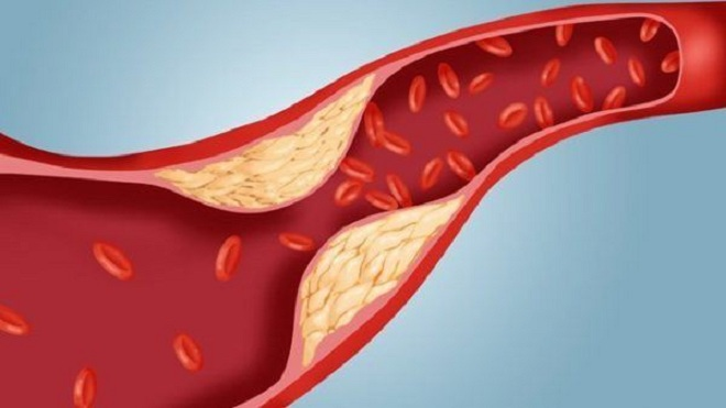 Viên sủi Bảo Mạch An: Thực phẩm bảo vệ sức khỏe hỗ trợ giảm cholesterol máu