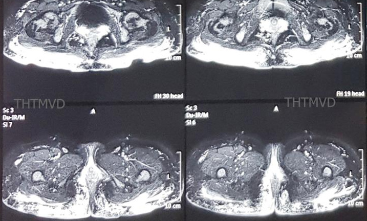 Hoại tử vòng 3 sau khi tiêm mỡ nhân tạo để tăng kích cỡ