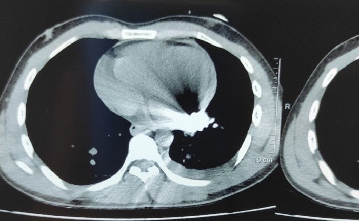 Cứu sống người đàn ông bị đạn nổ thủng tim khi đốt rác