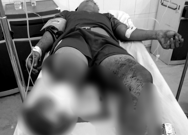 Hỗn chiến giữa đêm, thiếu niên 15 tuổi bị chém đứt lìa chân