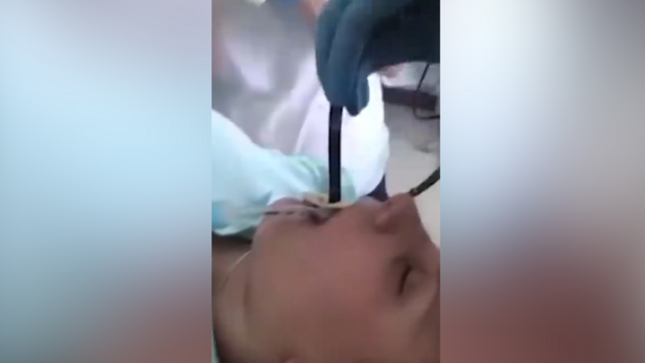 Thót tim cảnh lôi con rắn 1,2m khỏi cổ họng người phụ nữ 