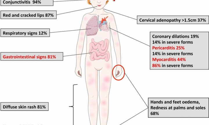 Australia ghi nhận bệnh nhân COVID-19 có hội chứng hiếm gặp