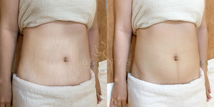 Trị rạn da bụng sau sinh với công nghệ Hàn Quốc từ BEAUTY S 