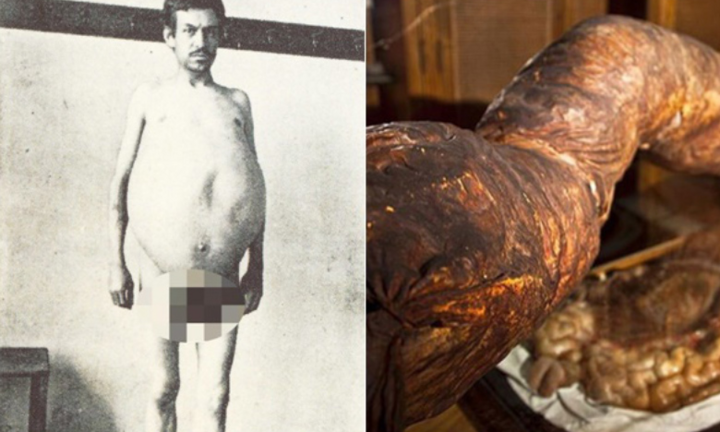 Người đàn ông chết khi cố đại tiện, ruột già được trưng bày trong bảo tàng Mỹ