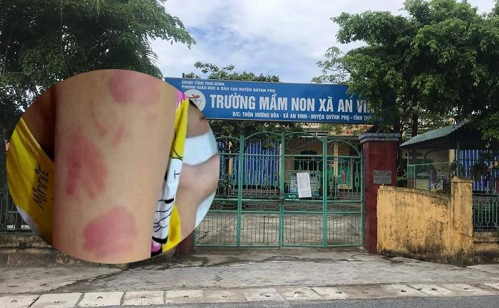 Bé 21 tháng tuổi ở Thái Bình bị bạn cắn tím người: Hiệu trưởng lên tiếng