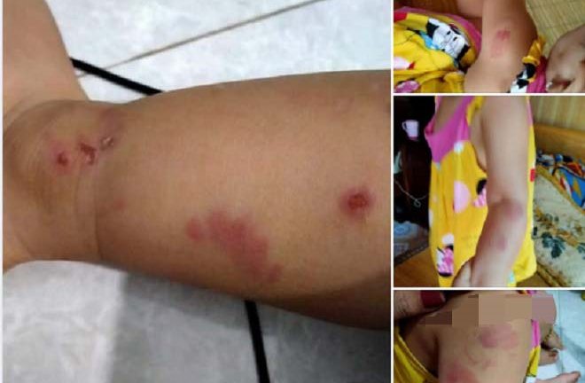 Bé 21 tháng tuổi bị bạn cắn tím người: Điều chuyển giáo viên phụ trách lớp