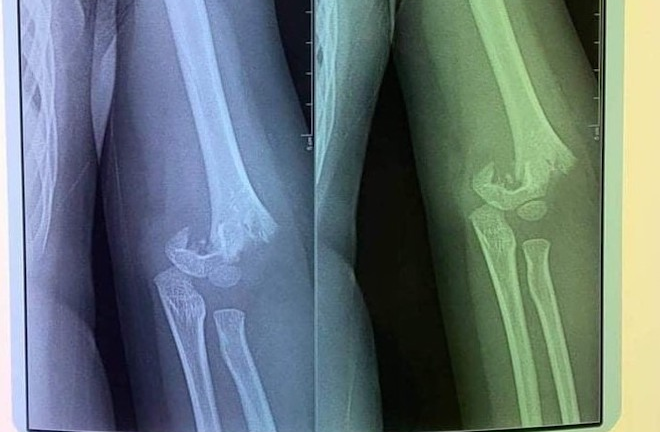 Bé 5 tuổi ở Hà Nội ngã gãy tay: Nhà trường lên tiếng