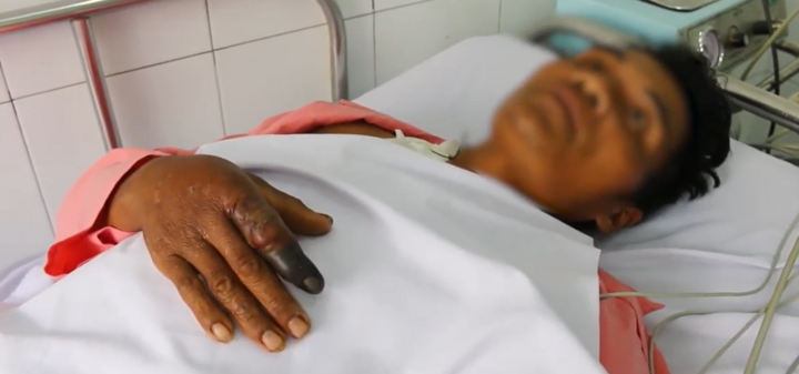 Cứu người đàn ông bị rắn hổ mang chúa dài hơn 2 mét cắn 