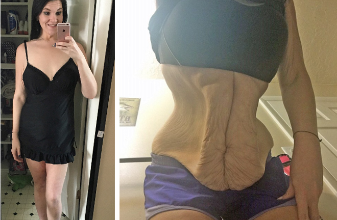 Vùng bụng nhăn nhúm của cô gái giảm 105kg trong 1 tháng khiến dân mạng khiếp sợ