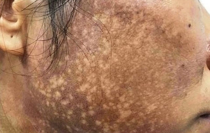 Da mặt như 'bánh đa vừng' vì bôi kem trộn làm trắng