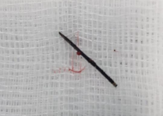 Phẫu thuật lấy kim khâu gỉ đen trong cơ thể bé 3 tuổi