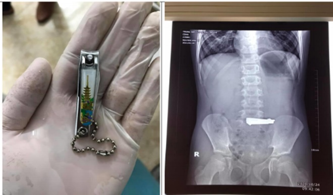 Bắt chước video trên youtube, bé trai 9 tuổi nuốt cả bấm móng tay vào bụng