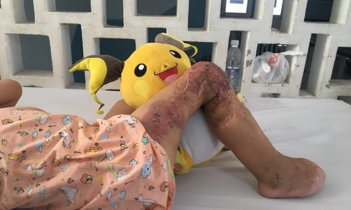 Xót xa nhìn đôi bàn chân bé gái mất 9 ngón sau 18 lần phẫu thuật