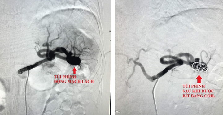  Người phụ nữ suýt chết vì phình động mạch lách