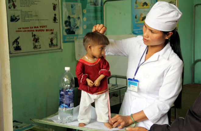 Hội chứng Seckel 'người tí hon': Triệu chứng là gì, phòng bệnh ra sao?