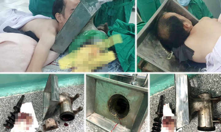 Nam thanh niên mang cối xay thịt 'nuốt' cánh tay đi cấp cứu