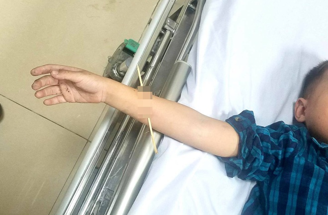 Bé trai ở Quảng Ninh bị que tre đâm xuyên cẳng tay