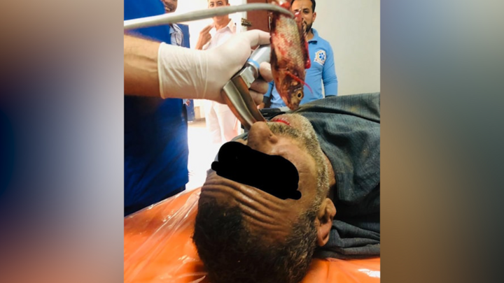 Video: Người đàn ông suýt chết vì cá chui vào cổ họng