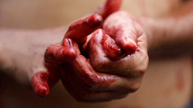 Người đầu tiên ở Việt Nam bị 'đổ mồ hôi máu' 