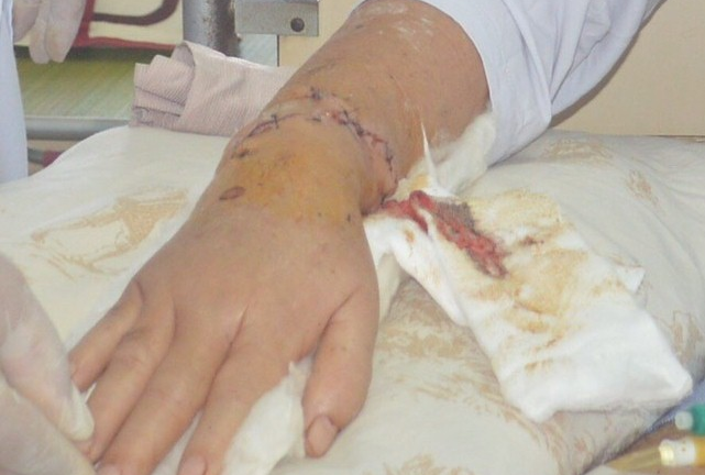 Người đàn ông 62 tuổi bị máy cưa cắt gần đứt lìa tay chân