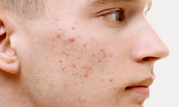 Hướng dẫn trị mụn đúng cách với khí hậu nóng ẩm và môi trường khói bụi Việt Nam