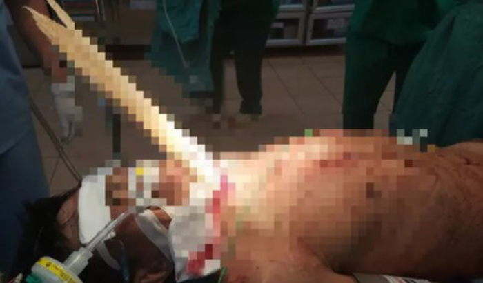 Cứu người đàn ông bị thanh gỗ nửa mét đâm xuyên cổ