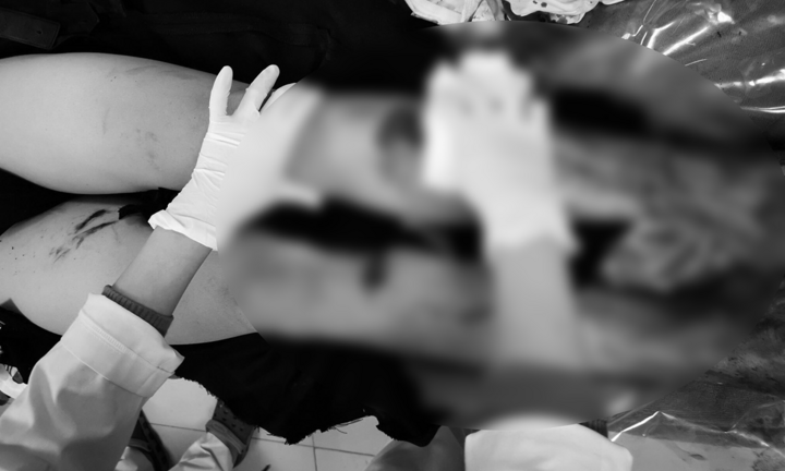 Tự chế pháo nổ, nam thanh niên bị dập nát bàn tay