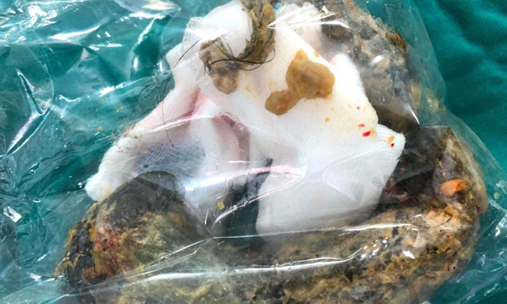 Bé gái 8 tuổi ở TP.HCM tắc ruột vì nghiện ăn tóc