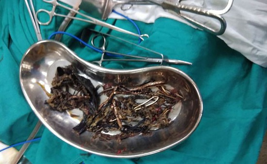 Thanh niên ở Bình Dương thích ăn kim loại: Bác sĩ lý giải nguyên nhân