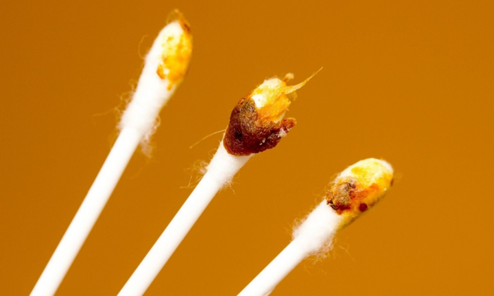  Màu sắc ráy tai tiết lộ tình trạng sức khỏe 