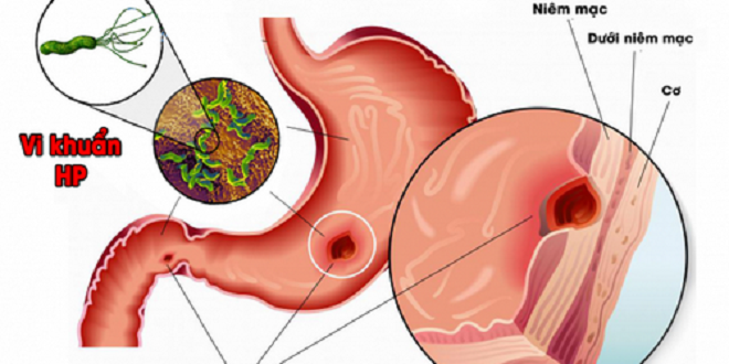 Viên uống Novacurmin hiệu quả thế nào cho người bị viêm loét dạ dày?
