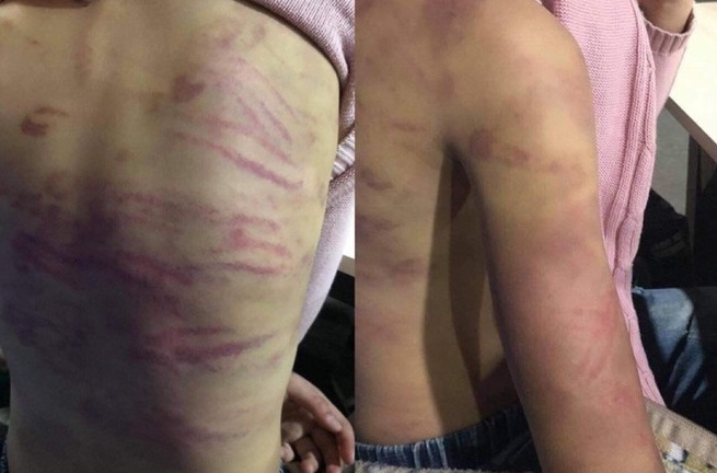 Bé gái nghi bị bạo hành, xâm hại: 'Bố không nhận nuôi, con sẽ vào trại mồ côi'