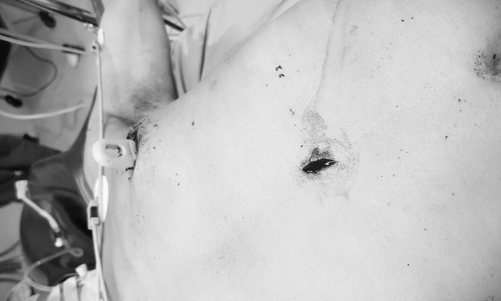 Cứu sống người đàn ông bị dao đâm thấu ngực