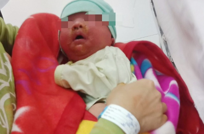 Tắm bằng nước lá cây, bé 20 ngày tuổi bị nhiễm độc nặng