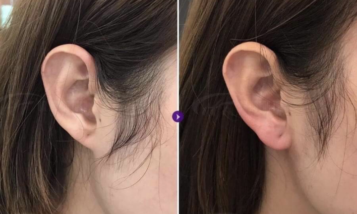 Tiêm filler vào vành tai, tài lộc chưa thấy đã phải nhập viện